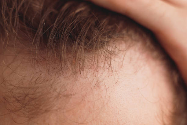 istock balding man is opening his forehead, close up view 1364623156