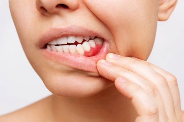 zahnfleischentzündung. cropped-aufnahme einer jungen frau mit rotem zahnfleischbluten - menschlicher zahn stock-fotos und bilder