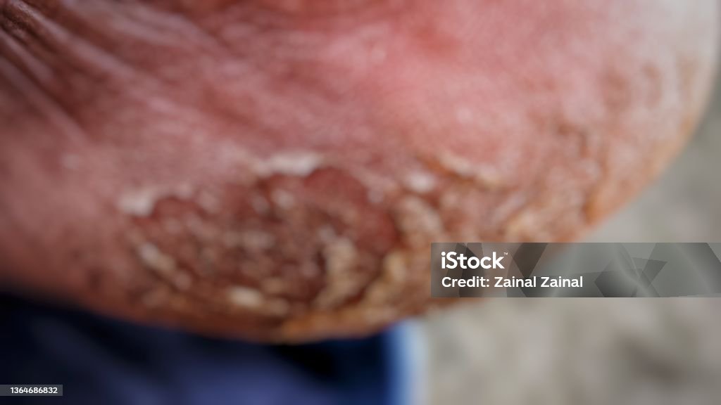 Piyoderma Keratoderma Yang Di Defocused Menutup Foto Stok - Unduh Gambar Sekarang ...