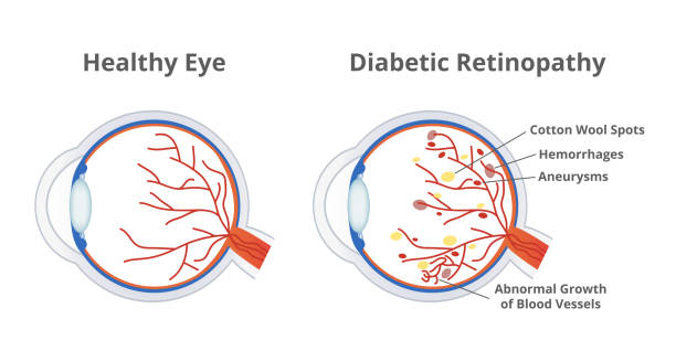 Vector illustration of diabetic retinopathy, a complication of diabetes caused by high blood sugar and normal healthy eye isolated. Cotton wool spots, hemorrhages, aneurysms, abnormal blood vessels. Vector illustration of diabetic retinopathy, a complication of diabetes caused by high blood sugar and normal healthy eye isolated on a white background. Cotton wool spots, hemorrhages, aneurysms, and abnormal growth of blood vessels. cornea stock illustrations