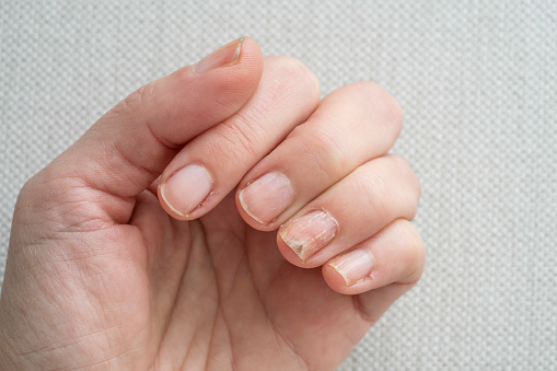 infección por hongos en las uñas en el dedo de la mano de la mujer blanca photo