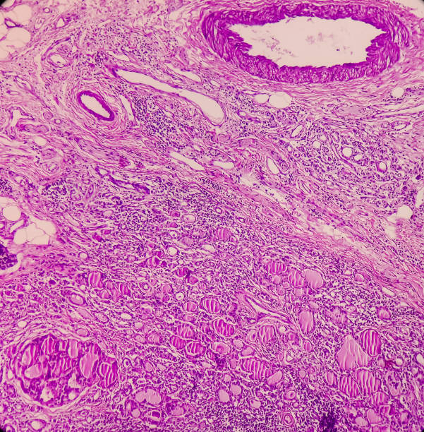 istock Thyroid gland(biopsy): Nodular goitre and lymphocytic thyroiditis, show thyroid follicles with cystic change 1364869276
