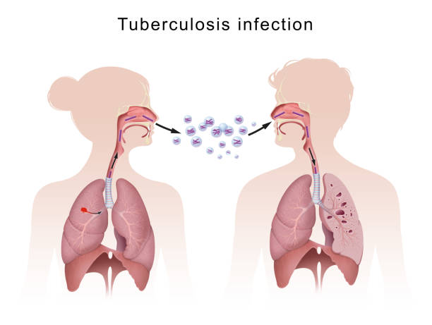illustrazioni stock, clip art, cartoni animati e icone di tendenza di la tubercolosi si diffonde da una persona all'altra attraverso l'aria - spitting