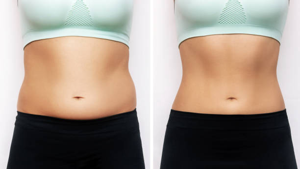 vientre de una mujer con exceso de grasa y estómago delgado tonificado con abdominales antes y después de perder peso - overweight women weight loss fotografías e imágenes de stock