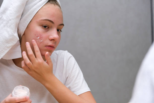 teenage girl . Acne. Care for problem skin Acne. A teenage girl applying acne medication on her face in front of a mirror. Care for problem skin acne stock pictures, royalty-free photos & images