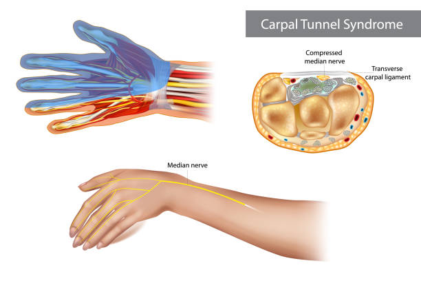 illustrazioni stock, clip art, cartoni animati e icone di tendenza di sindrome del tunnel carpale. nervo mediano compresso. anatomia del tunnel carpale, che mostra il nervo mediano. - tendine