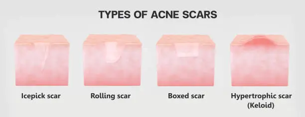 Types of acne scar troubles. Icepick, Rolling, Boxed and Hypertrophic scars isolated white background. 3D rendering