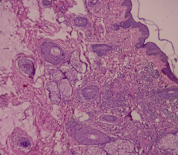 istock Tissue from face(biopsy): Microscopic image of intradermal nevus, show small nests of melanocytes with variable pigmentation and cellularity. 1365061830