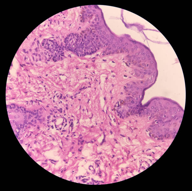 tejido de cara (biopsia): imagen microscópica del nevo intradérmico, muestra pequeños nidos de melanocitos con pigmentación y celularidad variables. - human tissue histology dermatology human skin fotografías e imágenes de stock