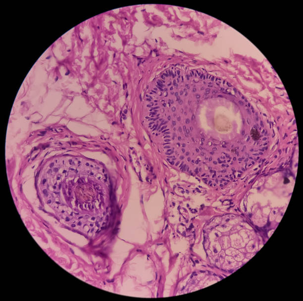 tejido de cara (biopsia): imagen microscópica del nevo intradérmico, muestra pequeños nidos de melanocitos con pigmentación y celularidad variables. - human tissue histology dermatology human skin fotografías e imágenes de stock