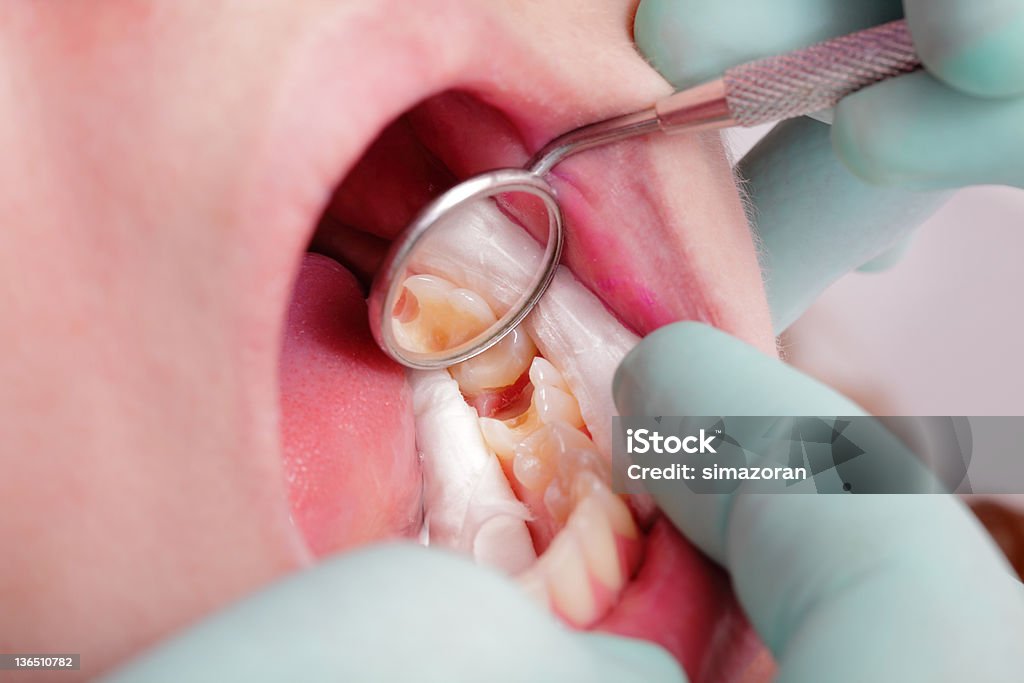 Dental Close up of hole in tooth after drilling with dental rolls and mirror Angled Mirror Stock Photo