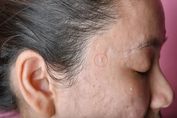 Photo of Acne pus, Close up photo of acne prone skin, Skin problem with acne diseases, Close up woman face with whitehead pimples.