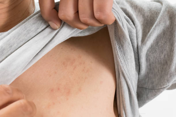 istock A man scratching urticaria in his left chest 1365129656