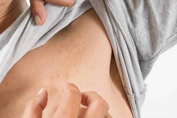 istock A man scratching urticaria in his left chest 1365131099