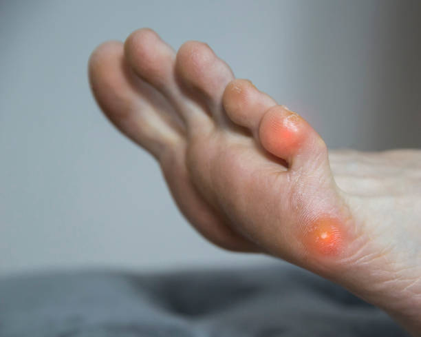 발에 발바닥 사마귀와 인간의 작은 발가락. 피부과에서 발바닥에 사마귀의 치료 및 제거. 텍스트 공간 복사 - pacient 뉴스 사진 이미지
