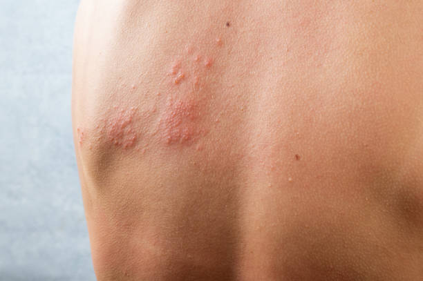 hautinfiziert herpes zoster virus. herpesvirus am körper. urtikaria hautausschlag. atopische dermatitis am körper - raised skin stock-fotos und bilder