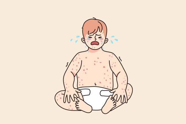 Unhappy baby crying suffer from eczema disease Unhappy baby infant crying suffer from eczema or dermatology disease. Upset sad little kid newborn child stressed with measles or chickenpox. Children healthcare concept. Vector illustration. measles illustrations stock illustrations