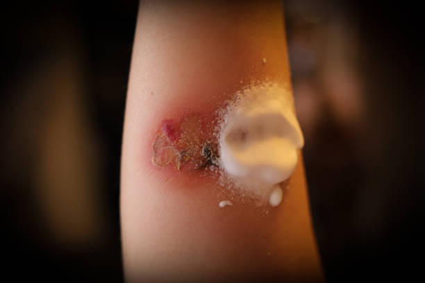 istock burn on the hand, treatment, first aid, application of medicine 1365544337