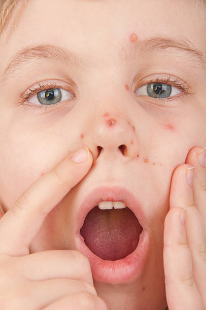 istock girl suffering from varicella 136555095