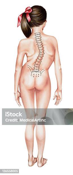 Colonne La Scoliose Vecteurs libres de droits et plus d'images vectorielles de Scoliose - Scoliose, Mauvaise posture, Squelette humain