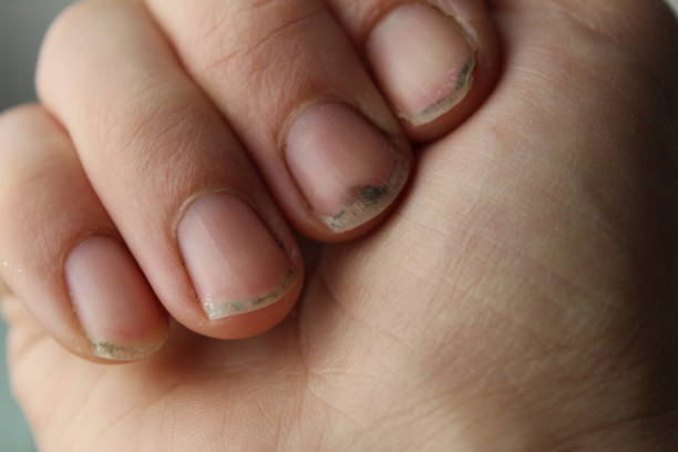 Uñas Sucias - Banco de fotos e imágenes de stock - iStock Uñas Sucias - Banco de fotos e imágenes de stock - iStock