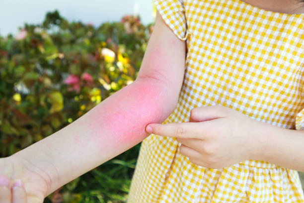 Little girl has skin rash allergy and itchy on her arm stock photo