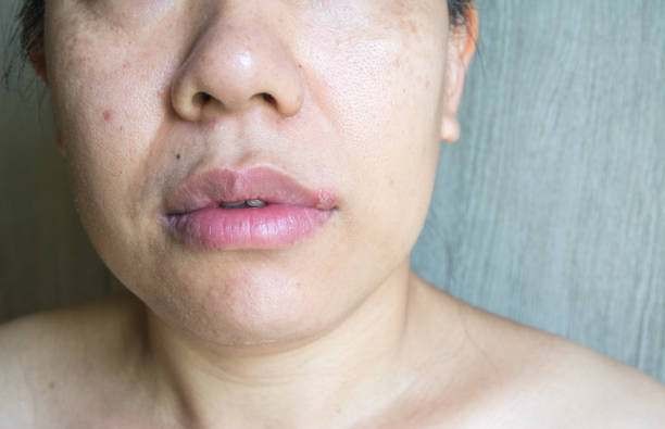 istock Close up a herpes simplex virus on lips women 1365744123