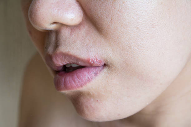 istock Close up a herpes simplex virus on lips women 1365744216