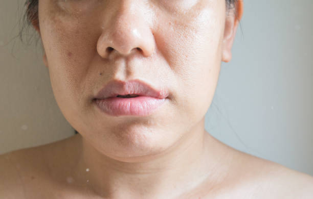 istock Close up a herpes simplex virus on lips women 1365744222