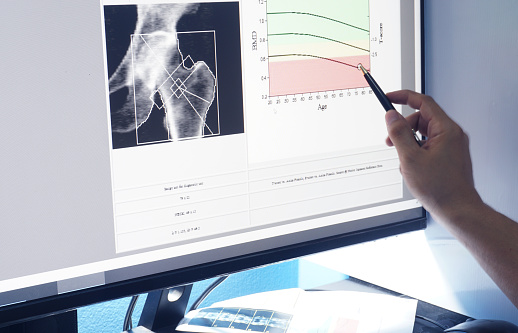 bone density hip results,Medical image concept.