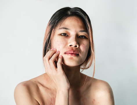 Mujer con alergia a la piel en todo el cuerpo rascándose la cara con erupción roja e infección de la piel. photo