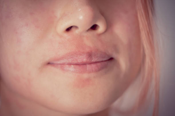 Asian woman suffering from Skin allergy from Cosmetic and Make up making her skin. closed up on mouth stock photo
