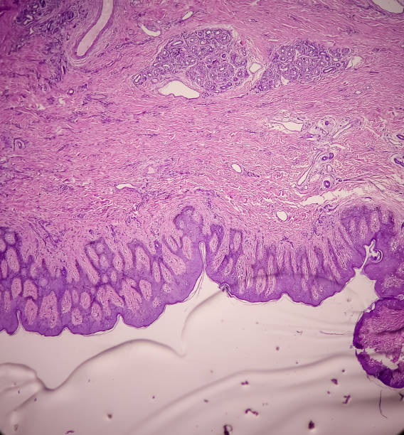 endometriosis cicatricial, imagen microscópica mostrar tejido fibrocolágeno, crecimiento de glándulas endometriales y estroma, es una enfermedad rara - cramping fotografías e imágenes de stock