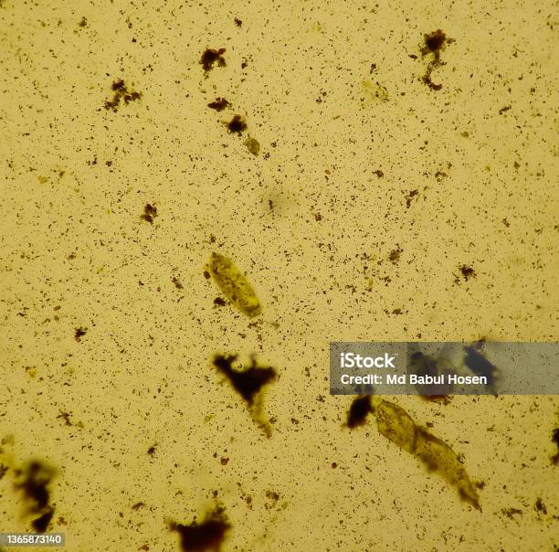 Python Stool Sample Under Microscope Stool Examination Under Light Microscopy Fat Globules Plenty Yeasts ...