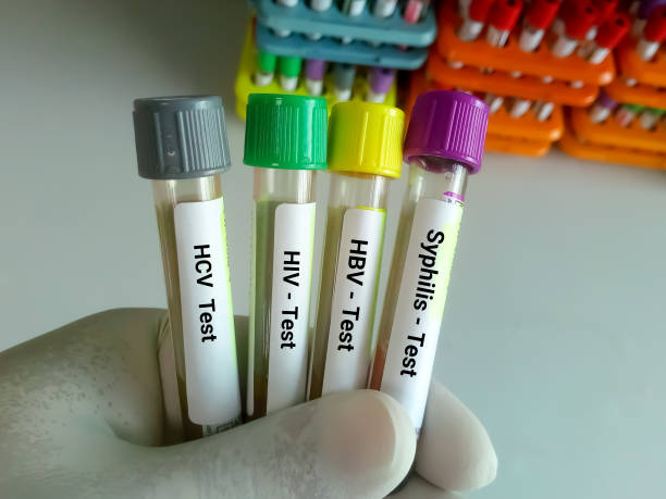lo scienziato detiene campioni di sangue in tubetto per malattie sessualmente trasmissibili. sifilide, hbv, hiv, hcv - aids test foto e immagini stock