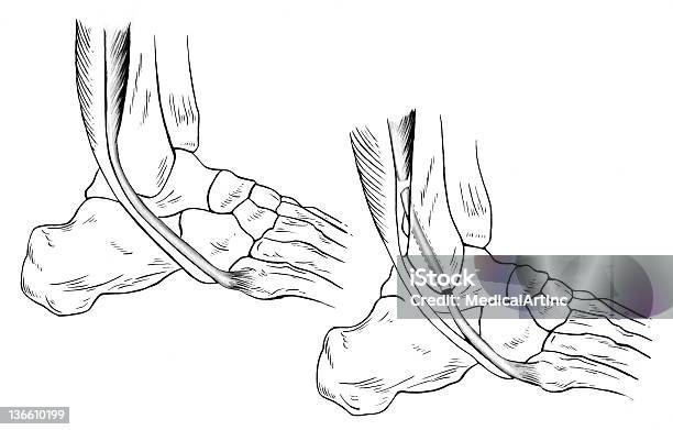 Ilustración de Tobillosprained y más Vectores Libres de Derechos de Hueso del pie - Hueso del pie, Anatomía, Articulación humana