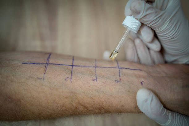 istock Skin prick allergy test 1366102819