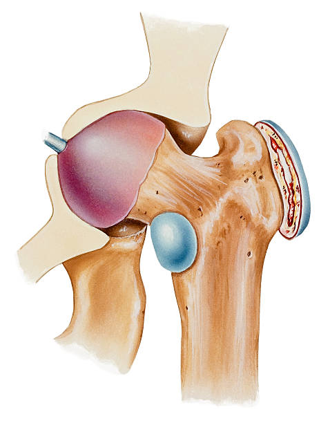 Hip - Bursitis Bursitis of the hip bursa(e), which can cause severe pain. A bursa is a fluid filled sac that facilitates the smooth motion of joints. Shown is bursitis of the trochanteric bursa between the bony prominence of the outside of the hip and the tendon that passes over it (right, blue) and iliopsoas bursitis (center, blue).. hip body part stock illustrations