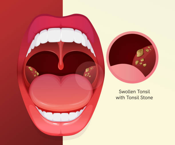 ilustrações, clipart, desenhos animados e ícones de boca aberta com dor de garganta e amigdalite - ilustração de estoque - tonsillite