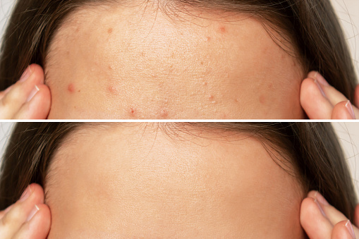 Cropped shot of a young woman's face before and after acne treatment on face. Pimples, red scars on the forehead of the girl. Problem skin, care and beauty concept. Dermatology, cosmetology