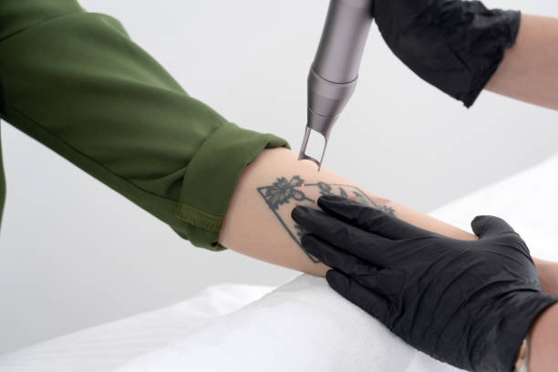 Beautician using laser device to remove an unwanted tattoo from female arm. Concept of erasing tattoos as an expensive procedure in a cosmetology clinic stock photo