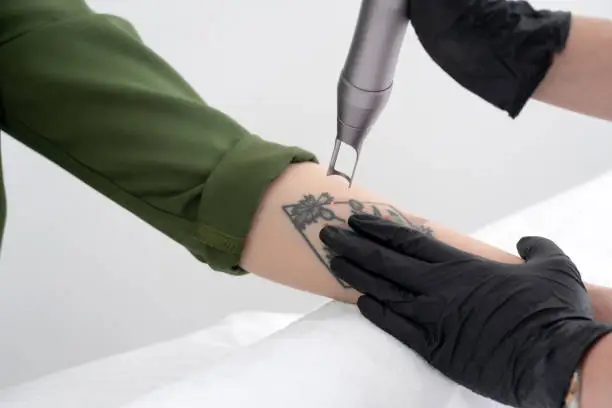 Photo of Beautician using laser device to remove an unwanted tattoo from female arm. Concept of erasing tattoos as an expensive procedure in a cosmetology clinic