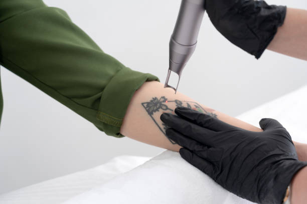 beautician using laser device to remove an unwanted tattoo from female arm. concept of erasing tattoos as an expensive procedure in a cosmetology clinic - removendo imagens e fotografias de stock