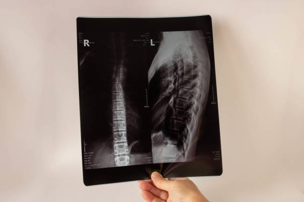 ティーンエイジャーの背中の医療x線。医療の概念 - pain rib cage x ray image chest ストックフォトと画像