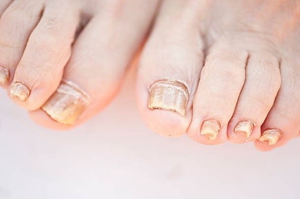 fungo de unhas - fungus toenail human foot onychomycosis - fotografias e filmes do acervo