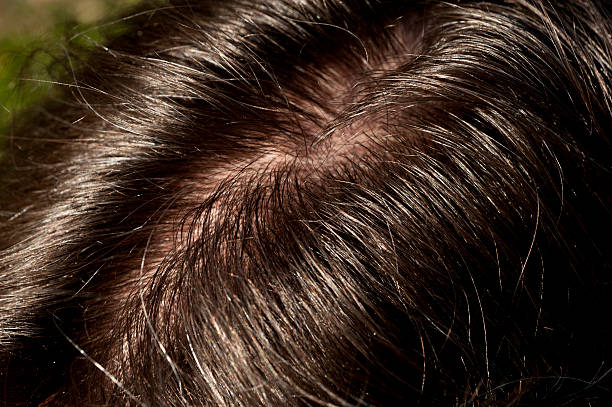 braunflecken-hairline - scheitel stock-fotos und bilder