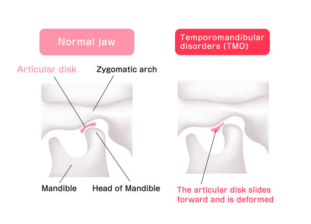 Illustration comparing the shapes of the articular disk ( normal jaw and Temporomandibular disorders ) Illustration comparing the shapes of the articular disk ( normal jaw and Temporomandibular disorders ) Temporomandibular Joint Disorder stock illustrations