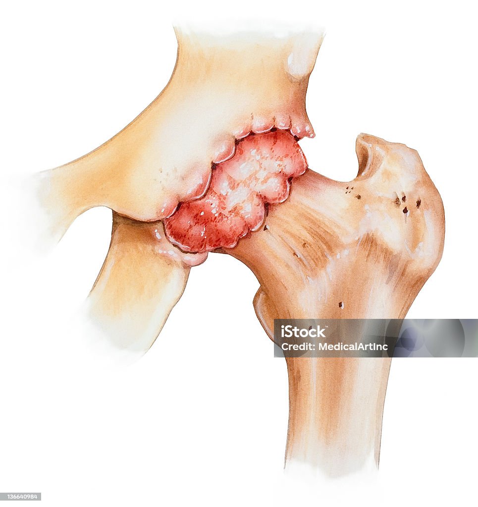 엉덩관절-골관절염 - 로열티 프리 골다공증 스톡 일러스트