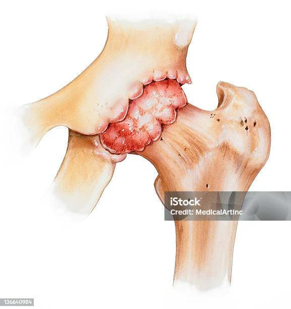 엉덩관절골관절염 골다공증에 대한 스톡 벡터 아트 및 기타 이미지 - 골다공증, 엉덩관절, 아픔