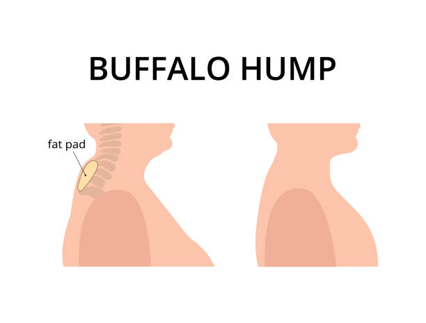 illustrations, cliparts, dessins animés et icônes de patient avec une bosse de buffle - hump